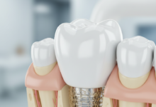 A photorealistic close-up of a perfectly integrated dental implant with a natural-looking white crown, set within healthy pink gum tissue. The background is a softly blurred, clean, and professional environment, highlighting the precision and strength of the dental restoration.