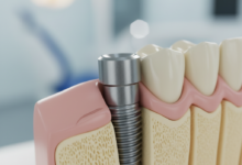 A photorealistic close-up of a titanium dental implant post partially embedded within stylized jawbone and surrounded by healthy gum tissue, representing the dental implant procedure in a clean, modern setting.