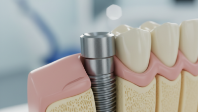 A photorealistic close-up of a titanium dental implant post partially embedded within stylized jawbone and surrounded by healthy gum tissue, representing the dental implant procedure in a clean, modern setting.