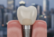 A photorealistic close-up of a natural-looking dental crown on an implant, seamlessly integrated into gum tissue, with a softly blurred modern Canadian city skyline in the background.