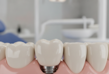 A highly detailed, close-up shot of a pristine white dental implant crown seamlessly integrated into healthy gum tissue, surrounded by natural teeth. The underlying titanium post is subtly visible through the gum, indicating its stability. The background is a soft blur of a clean, modern dental office, conveying professionalism and advanced technology.